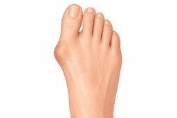 Bunion correction