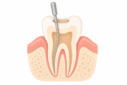 Root canal