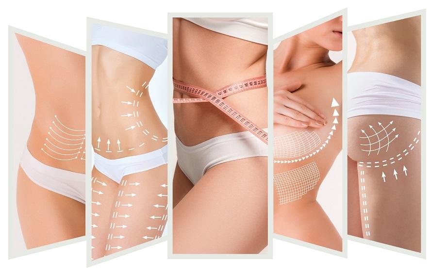 Cirurgia de Lifting Corporal