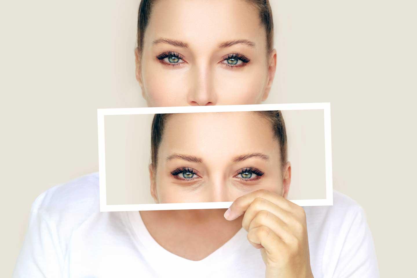Blepharoplasty Eye Lid Surgery