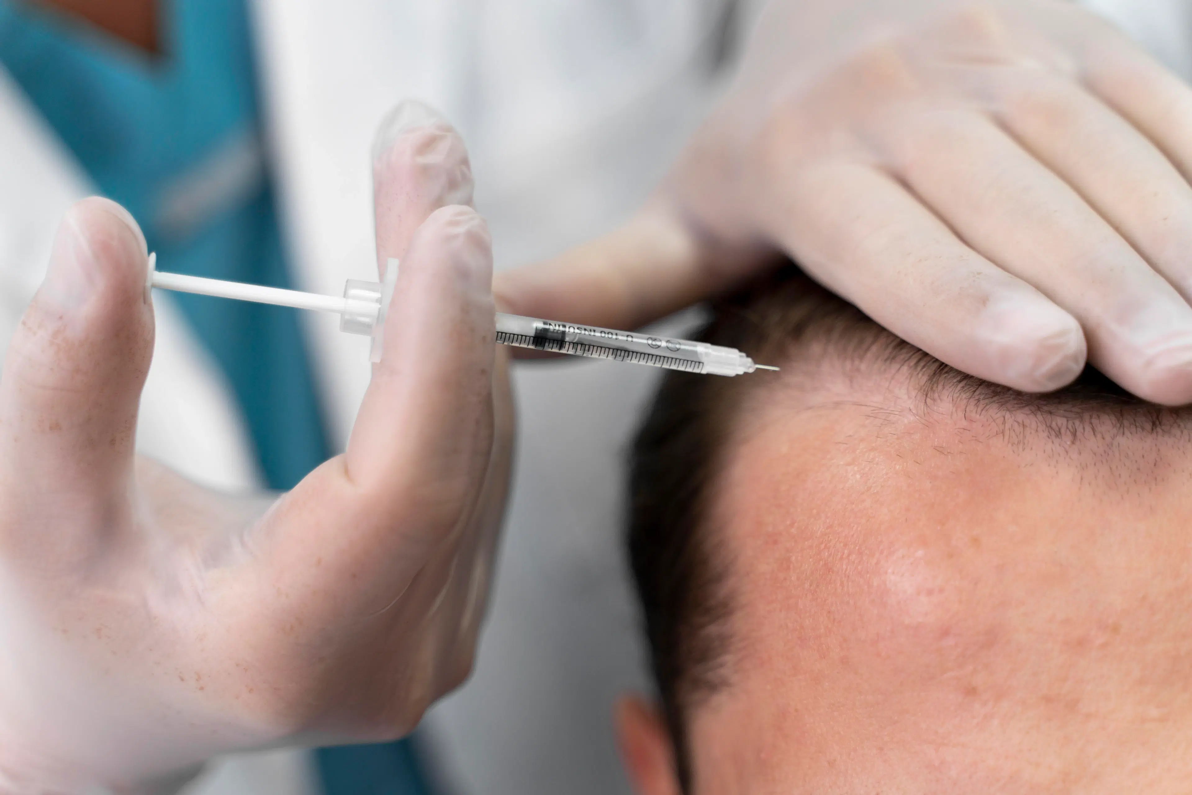 hair transplant in Vancouver
