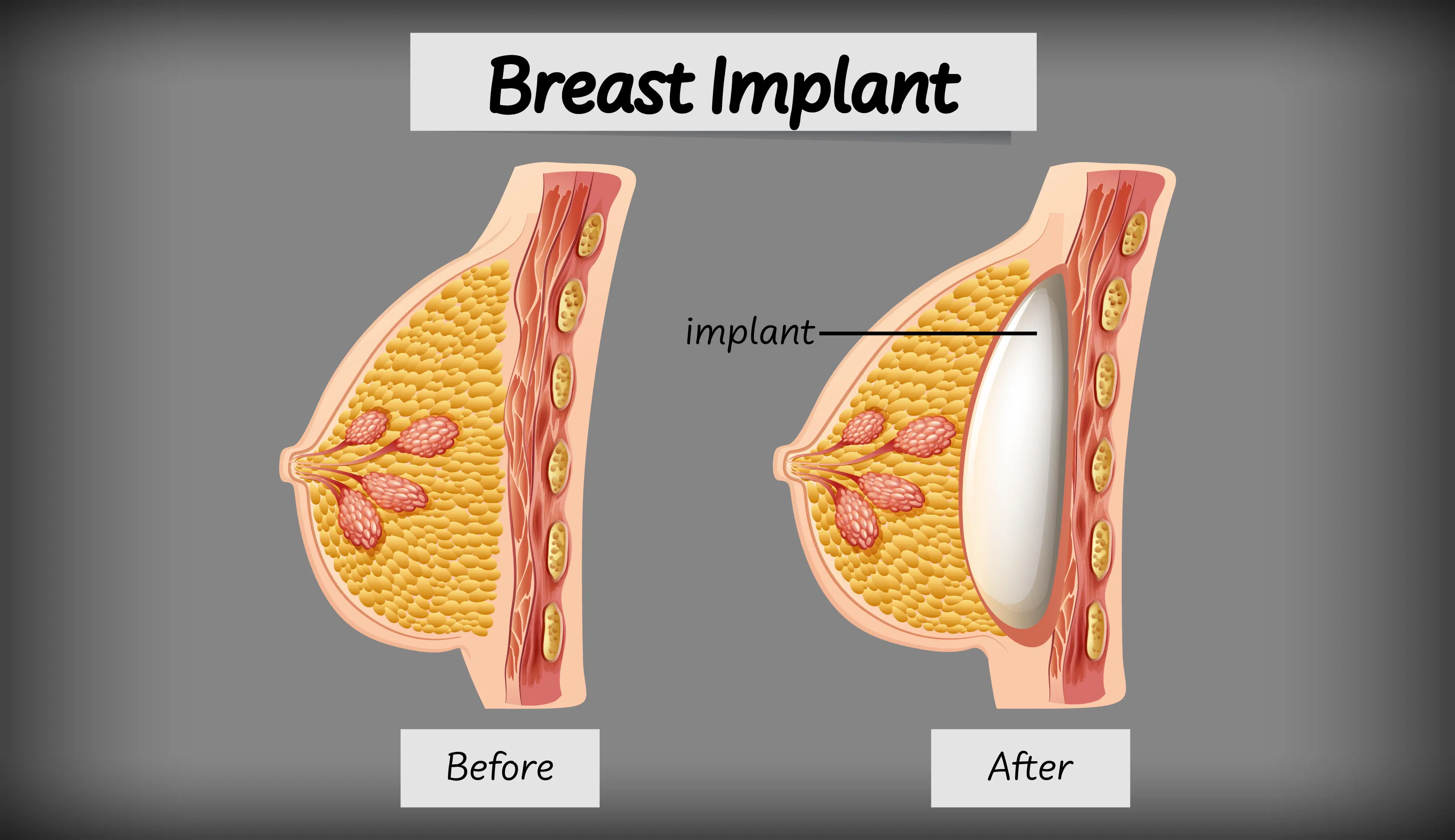 Breast Augmentation in New York