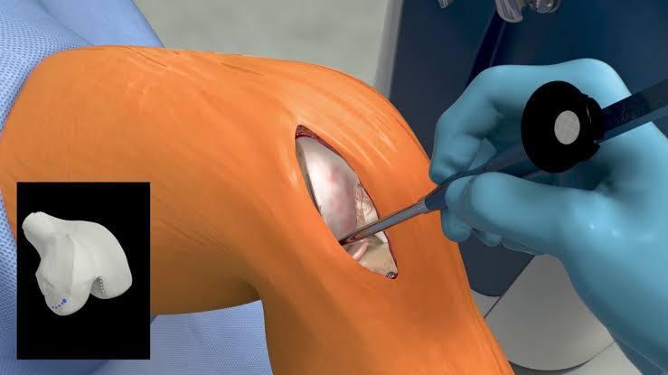 Unilateral Knee Replacement at Medicana, Istanbul, Turkey