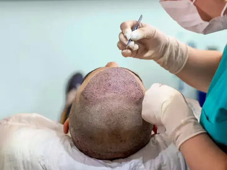 Hair Transplant at HairNeva Clinic