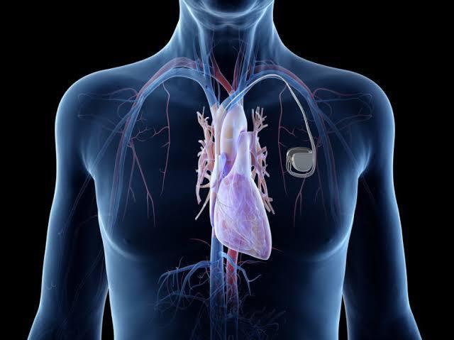 Pacemaker Implantation at Saudi German, Dubai, UAE