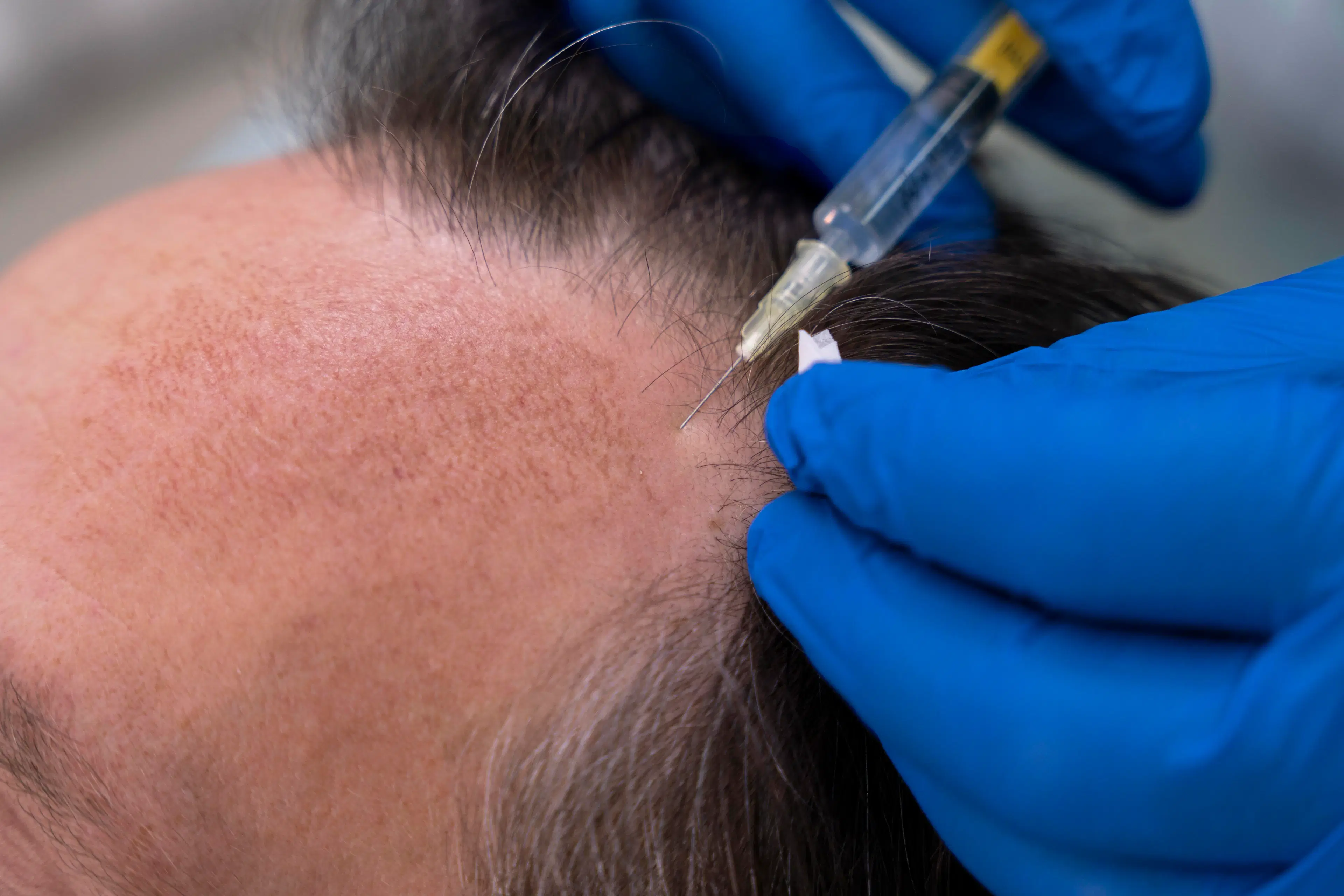 hair transplant in Emeryville