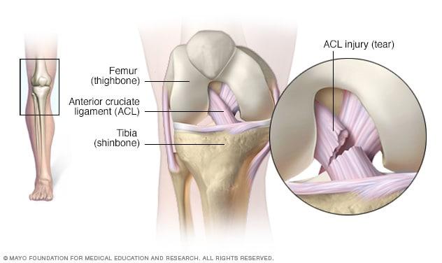ACL Reconstruction