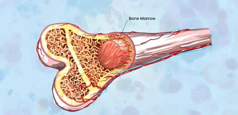 Bone Marrow Transplant at BLK-Max, New Delhi, India