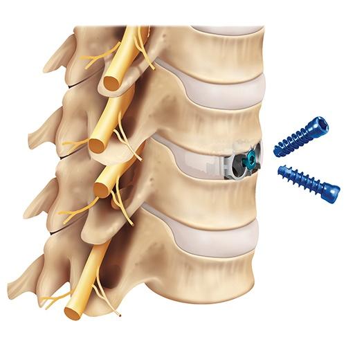 Anterior cervical discectomy and fusion (ACDF)