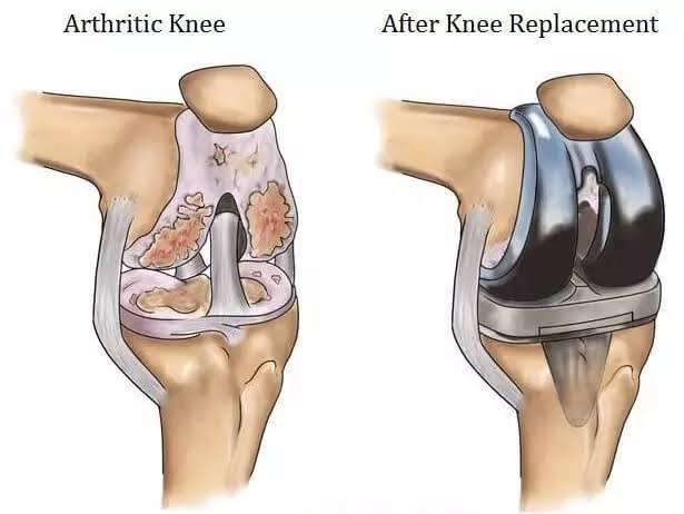 Unilateral Knee Replacement at Artemis, Gurgaon, India