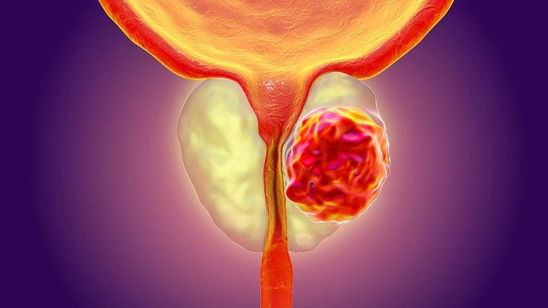 HOLEP Surgery at Saudi German, Dubai, UAE