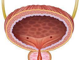 HOLEP Surgery at Artemis, Gurgaon, India