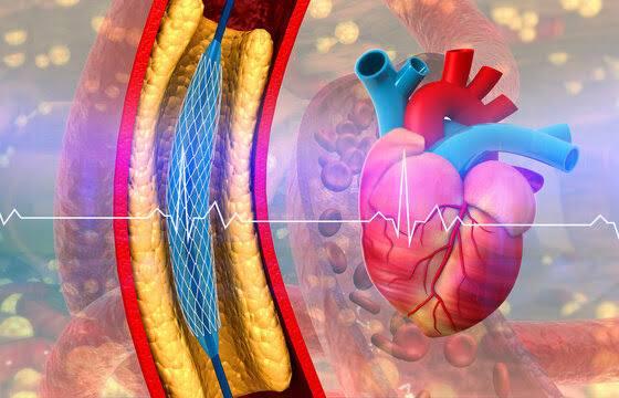 Coronary Angioplasty at Saudi German, Dubai, India