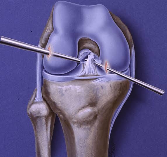 ACL Reconstruction at Saudi German