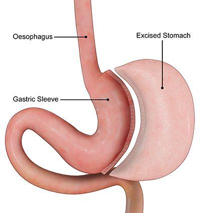 Gastric Sleeve Surgery at Saudi German, Dubai, UAE