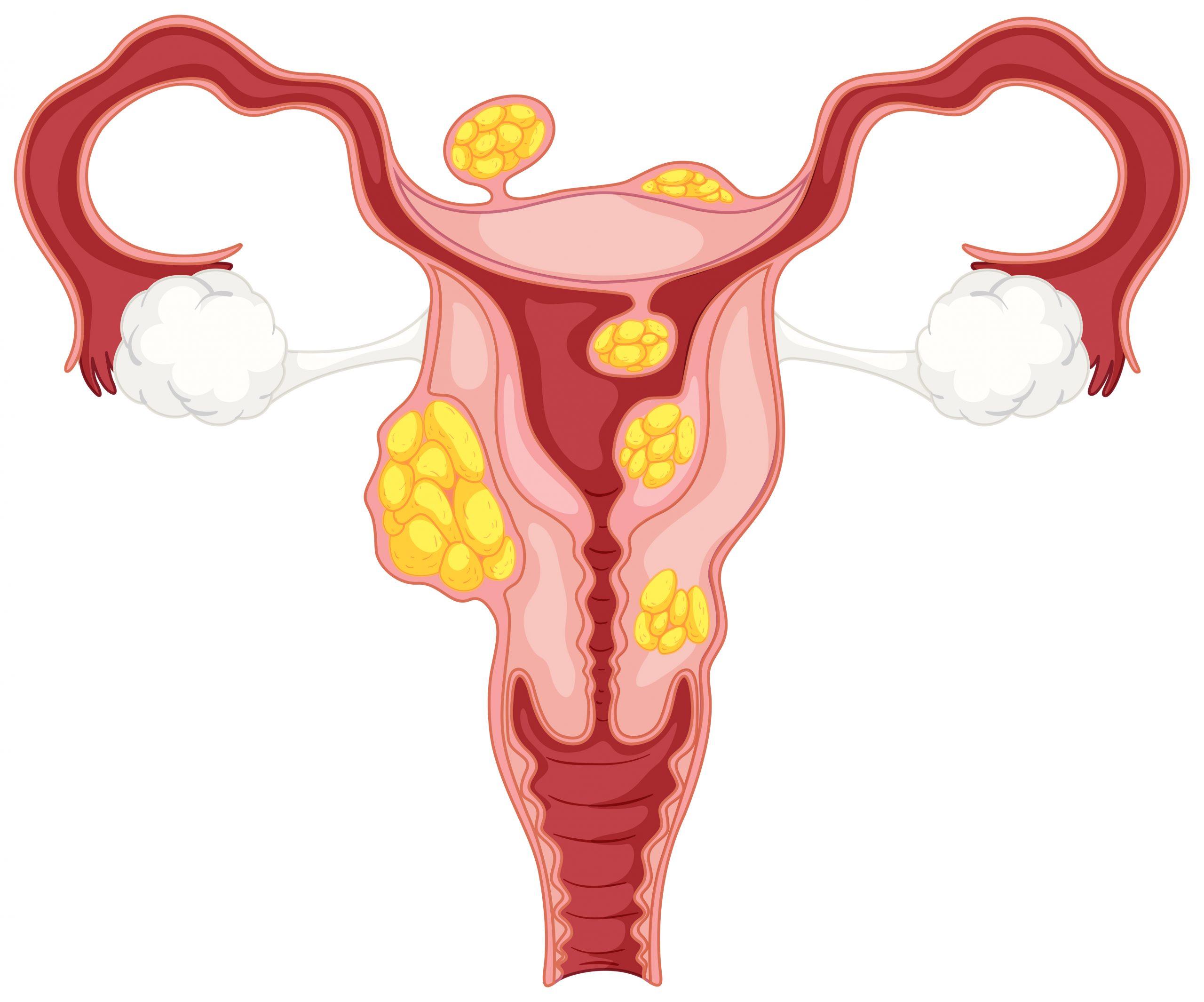 Laparoscopic Myomectomy at Paras Hospitals, Gurgaon