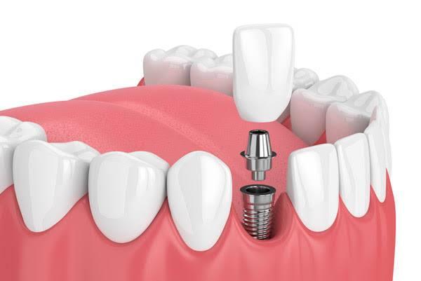 Dental Implants at American Hospital Istanbul