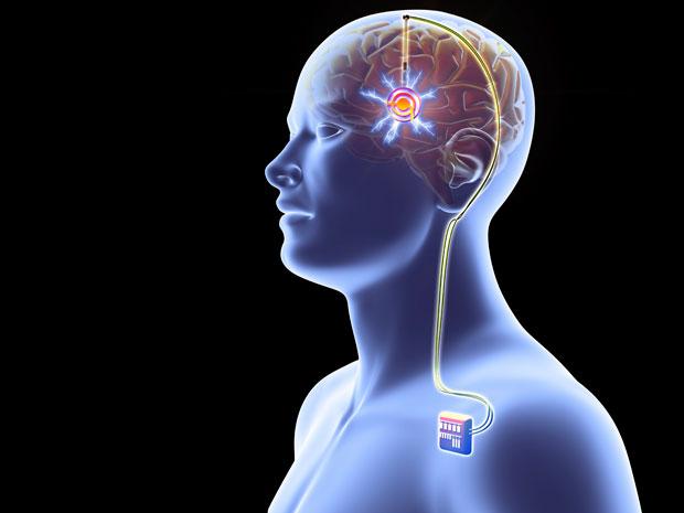Deep Brain Stimulation at Artemis Hospital, Gurgaon