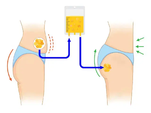 Brazilian Butt Lift at CK Birla