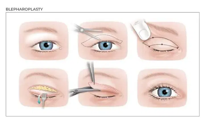 Blepharoplasty at CK Birla Hospital
