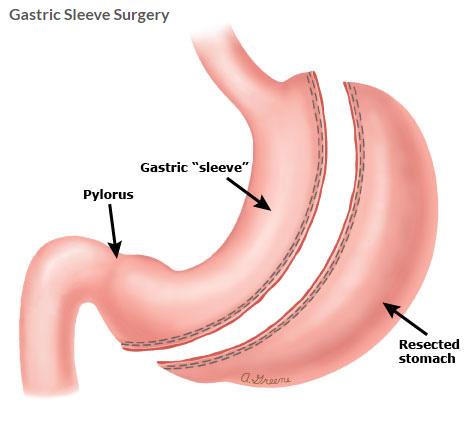 Gastric Sleeve Surgery at CK Birla, Gurgaon, India