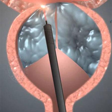 transurethral resection of the prostate (TURP) at Medicana Istanbul