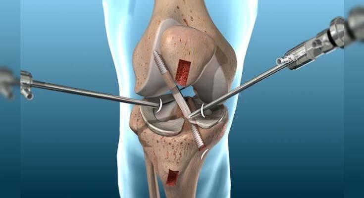 ACL Reconstruction at Medicana Istanbul