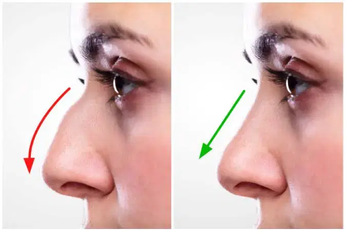 Cosmetic Rhinoplasty at CK Birla, Gurgaon, India
