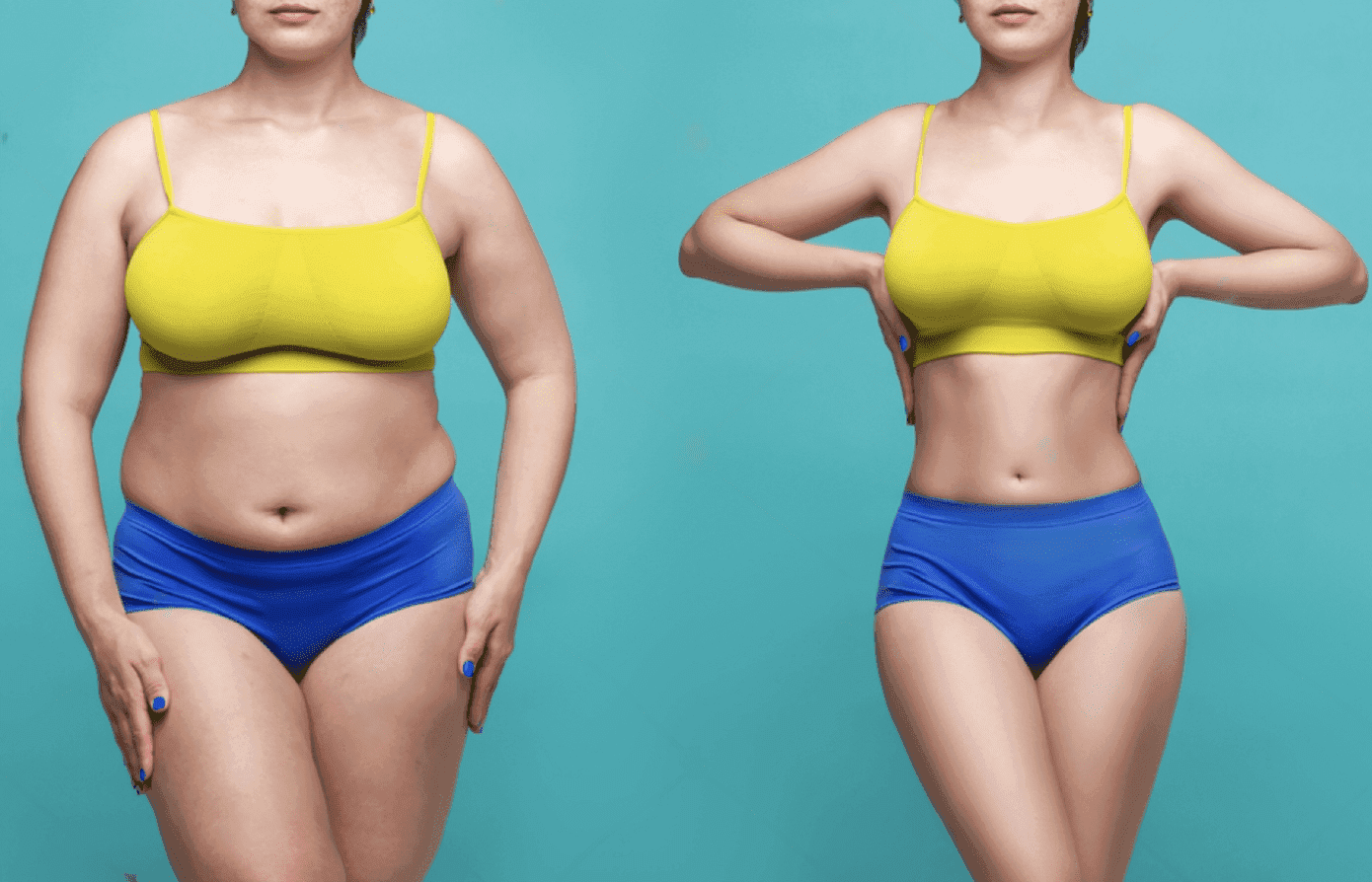 Liposuction Surgery at CK Birla Hospital, Gurugram