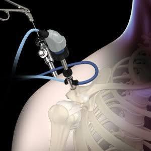 Shoulder Arthroscopy at Medical Park Istanbul, Turkey